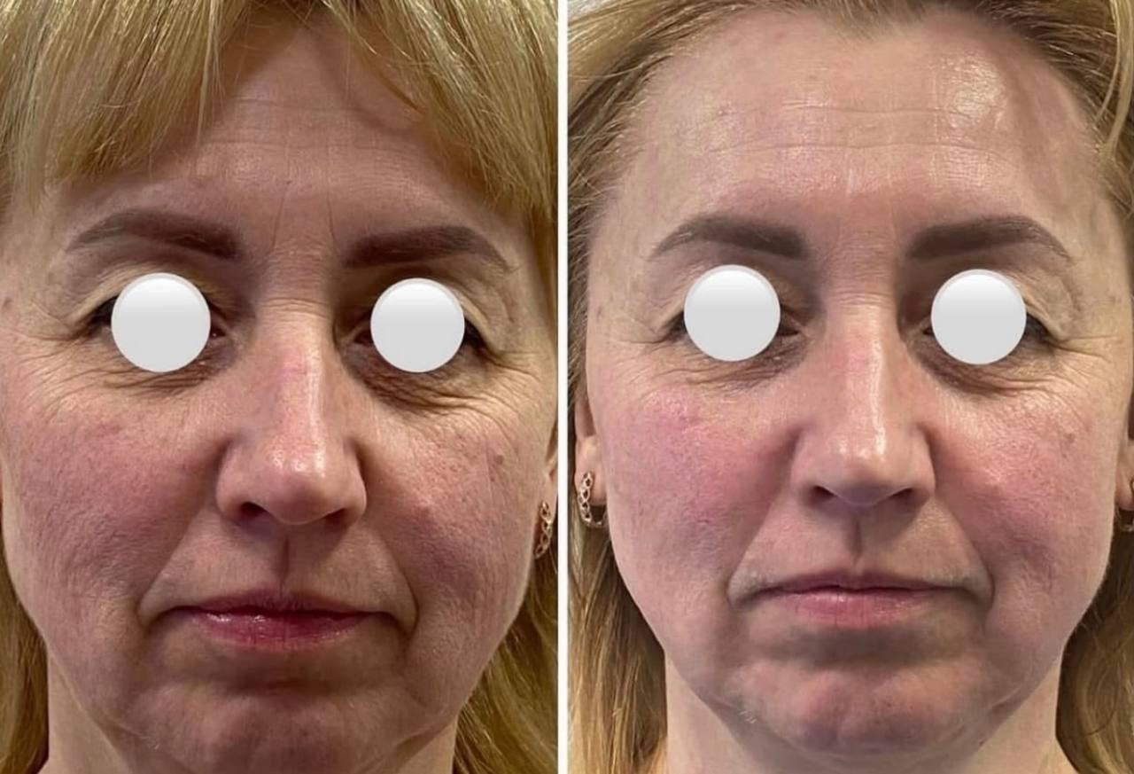 Moters veido palyginimas prieš ir po masažo, rodantis masažo poveikį