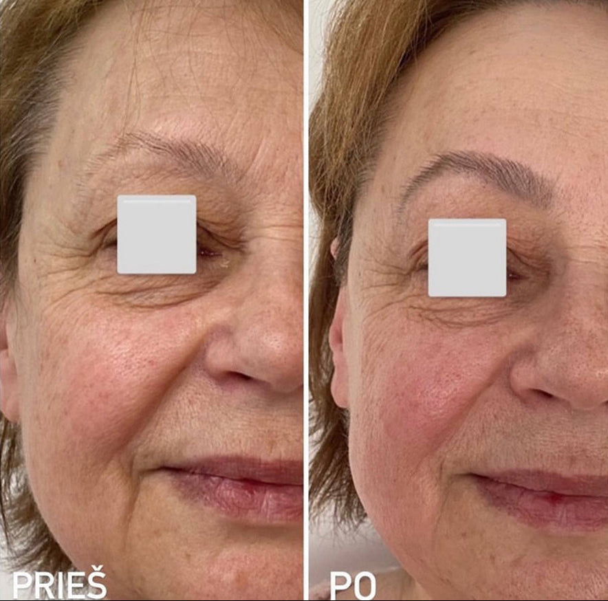 Moters veido palyginimas prieš ir po masažo, rodantis masažo poveikį