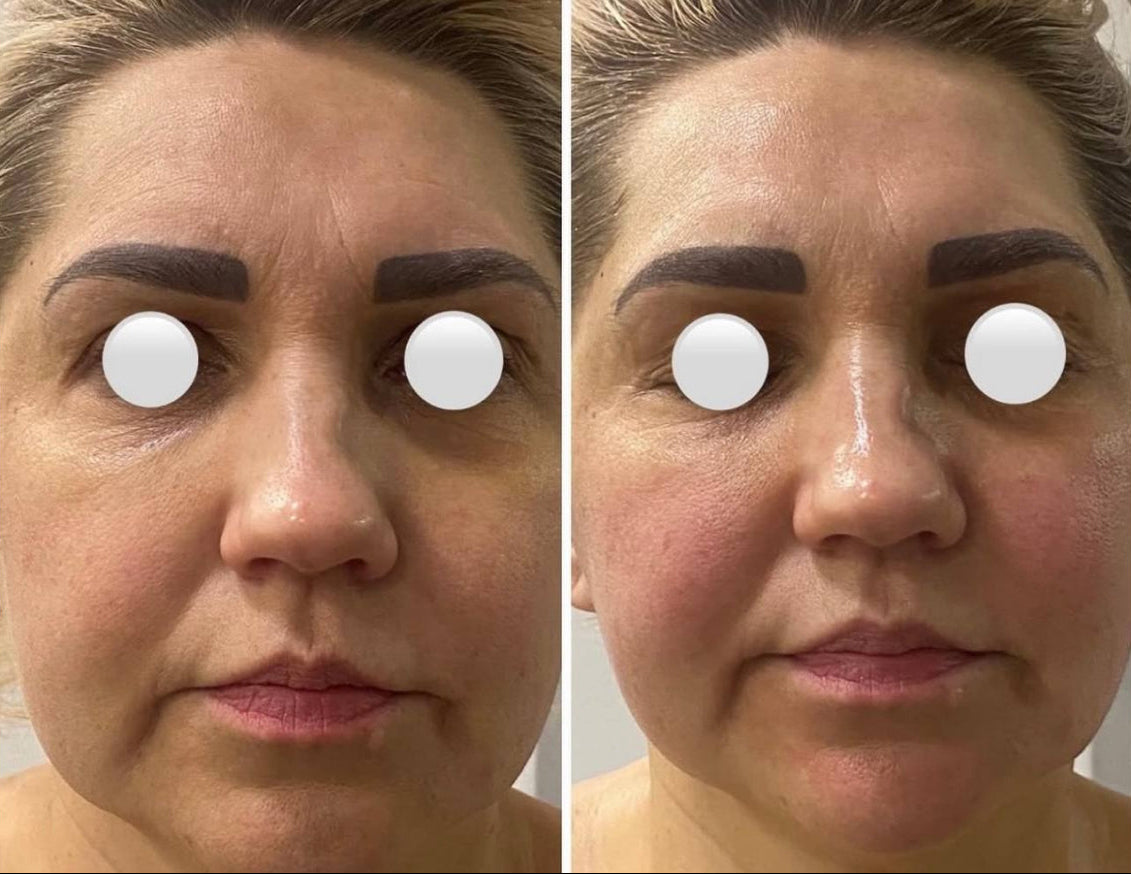 Moters veido palyginimas prieš ir po masažo, rodantis masažo poveikį