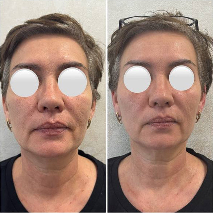 Moters veido palyginimas prieš ir po masažo, rodantis masažo poveikį