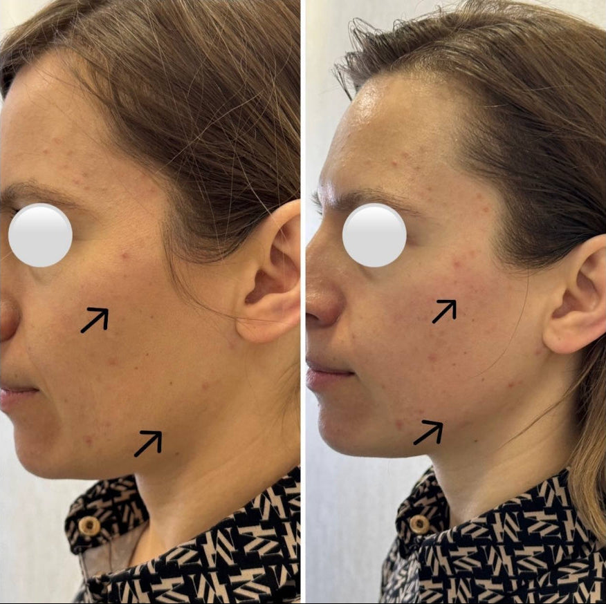 Moters veido palyginimas prieš ir po masažo, rodantis masažo poveikį