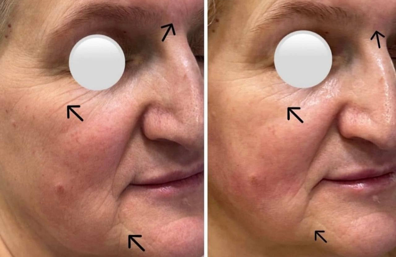 Moters veido palyginimas prieš ir po masažo, rodantis masažo poveikį